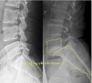 Trượt đốt sống thắt lưng